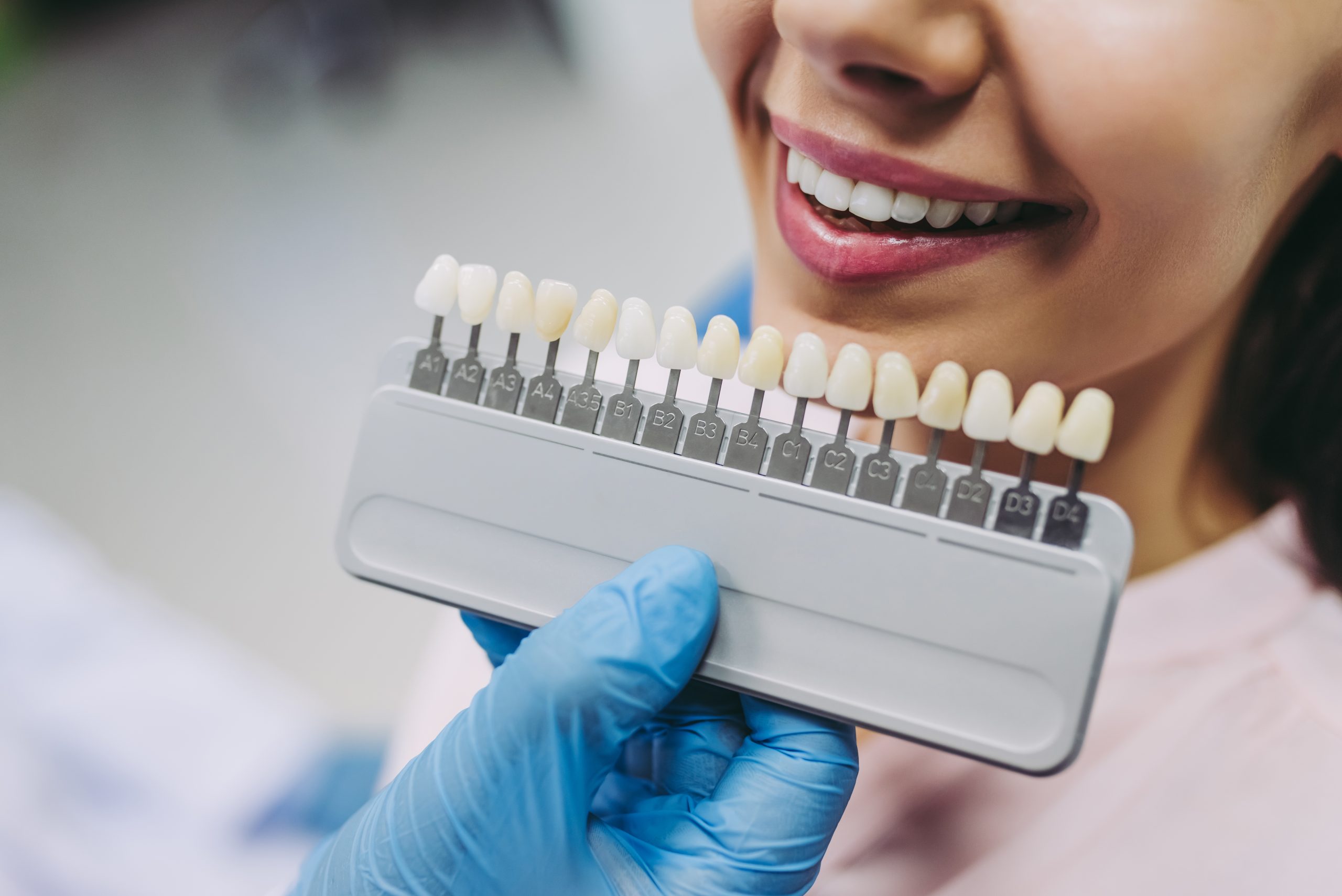 Dental Veneers in Mexico MexicoDent Pricelist