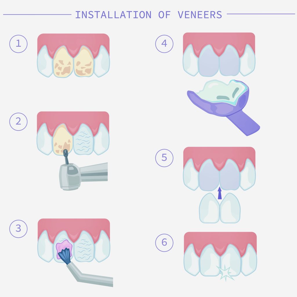 Dental Veneers in Mexico MexicoDent Pricelist
