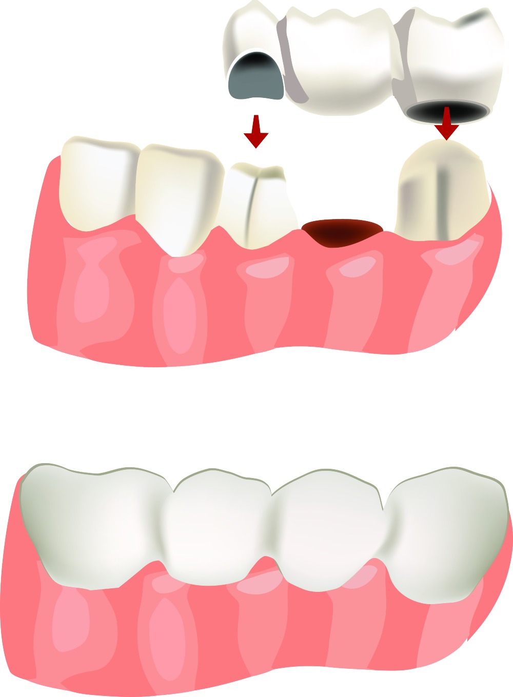 3 Unit Dental Bridge Cost in Mexico Mexicodent
