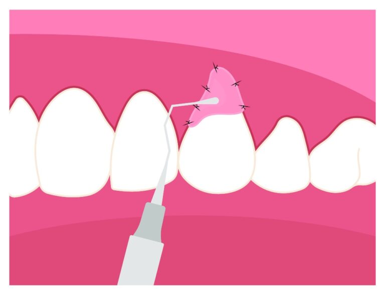 Gum Graft Cost in Mexico Treatment for Receding Gums