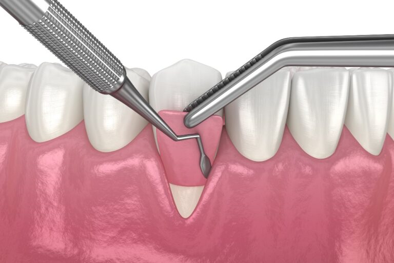 Gum Graft Cost in Mexico Treatment for Receding Gums