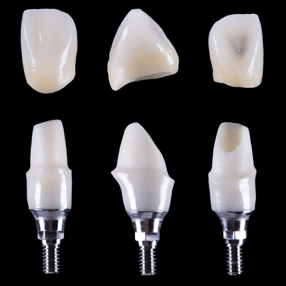 Zirconia Dental Crown Price in Mexico