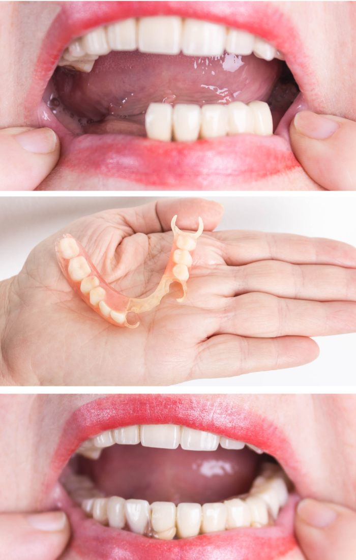 Affordable Partial Dentures in Mexico